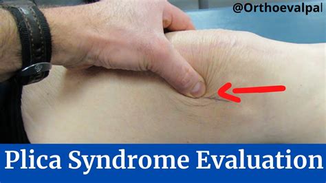 Plica Syndrome Evaluation Of The Knee Youtube