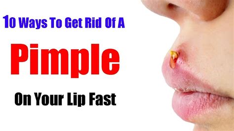 10 Ways To Get Rid Of A Pimple On Your Lip Fast Youtube