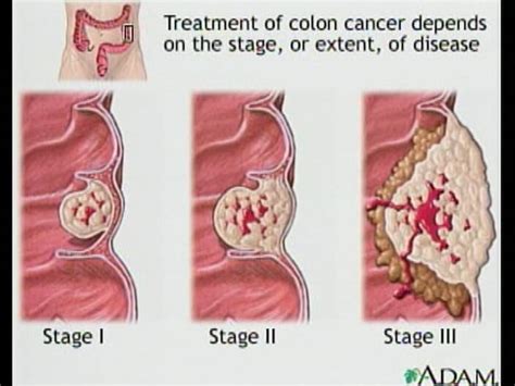 Blood In Stool And Cancer