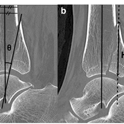 A Distal Tibia Diaphyseal Fracture With Associated Pmf B Ct