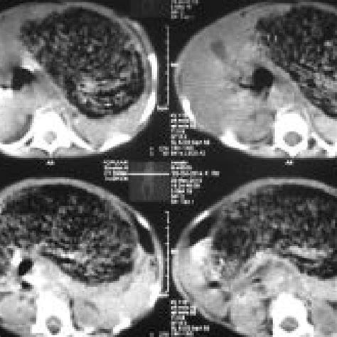 Contrast Enhanced Ct Scan Of Abdomen Shows Gastric Lactophytobezoar