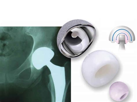 Stryker Lfit V40 Hip Implant Lawyer In Dallas Free Case Evaluation