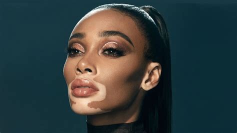 5 Celebrities With Vitiligo Ghp News