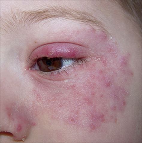 Common Features Of Periocular Tinea Dermatology Jama Ophthalmology