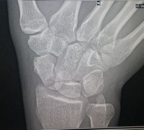 Scaphoid Fracture Hand Orthobullets