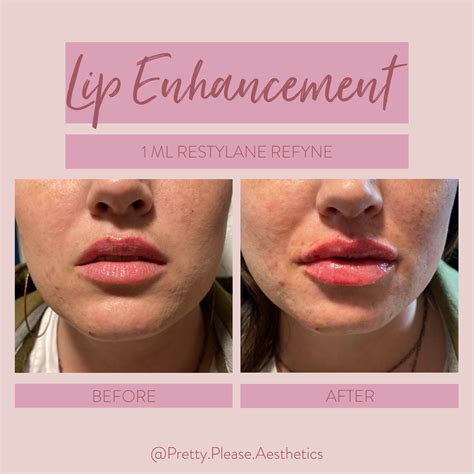 Lip Filler Before And After 1 Syringe Restylane Refyne After Pictures