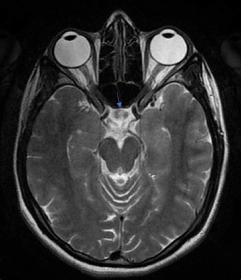 Cureus Mri Imaging Of Double Pituitary Microadenoma A Rare