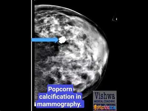 Popcorn Calcification In The Breast Is The Classical Description By