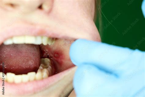 Foto De Painful Ulcer And Stomatitis On The Mucous Cheek Of A Girl