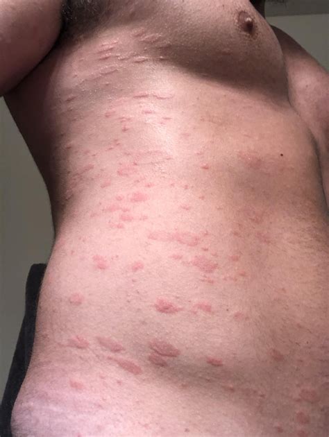 Is This Pityriasis Rosea Ive Had It Very Gradually Worsen For Nearly