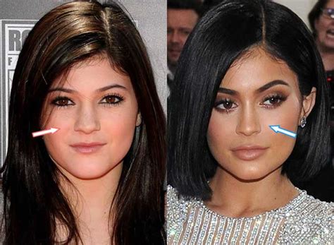 Kylie jenner before plastic surgery you can find fascinating photos! Kylie Jenner Before and after: Nose Job, Lip Injections ...