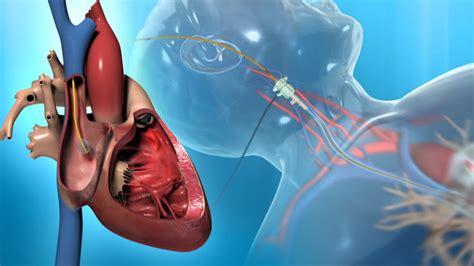 Right Heart Catheter For The Diagnosis Of Pah Youtube