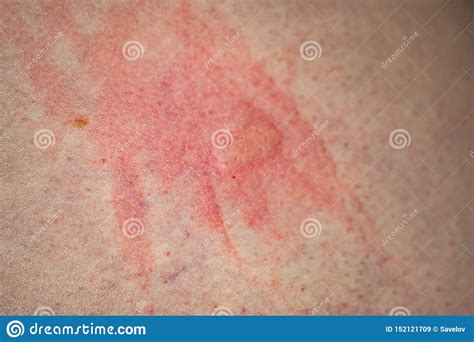 Red Bite From The Bug On The Skin Close Up Stock Image Image Of Pain