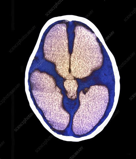 Hydrocephalus Ct Scan Stock Image C0180567 Science Photo Library
