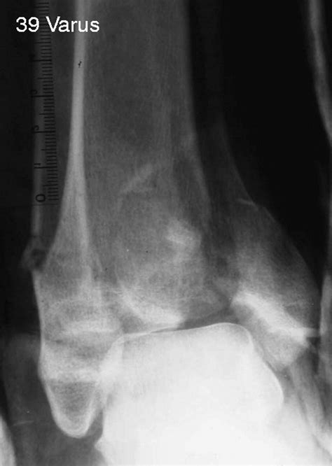 Anatomy Of Pilon Fractures Of The Distal Tibia Bone And Joint