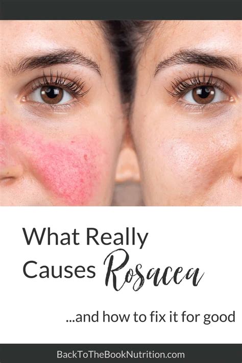 What Really Causes Rosacea And How To Overcome It Naturally Artofit