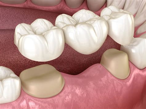 Cosmetic Dentistry Procedures 3 How Do Dental Bridges Work