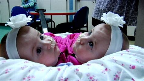 Once Conjoined Twins Make Debut After Surgery Abc News