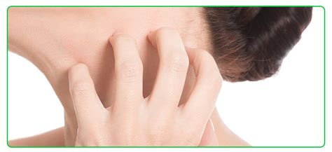 Seborrheic Dermatitis Face Treatment Natural Remedies Prescription Drugs