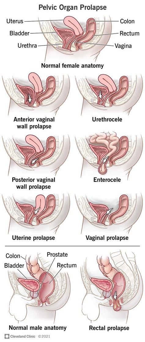 Pelvic Organ Prolapse Types Causes Symptoms Treatment The Best Porn Website