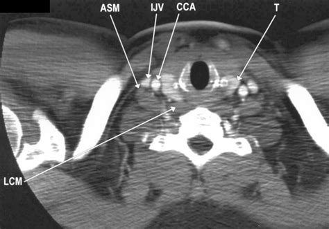 Sonographically Guided Biopsy Of Supraclavicular Lymph Nodes A Simple