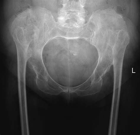 Developmental Dysplasia Of The Hips Radiology At St Vincent S My Xxx