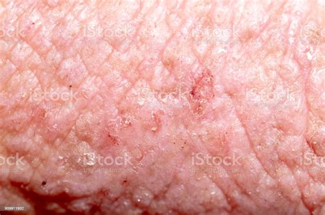 Atopic Dermatitis Stock Photo Download Image Now Istock