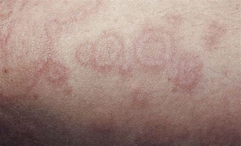 Rashes And Fever In Children Sorting Out The Potentially Dangerous