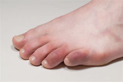 Chilblains The Cold Weather Red Toes How To Prevent And Cure
