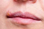 Herpes on the lip close up macro containing problem, illness, and face ...