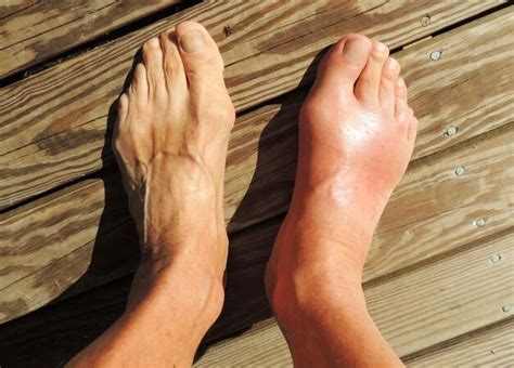 Is A Stress Fracture Serious — Pioneer Podiatry