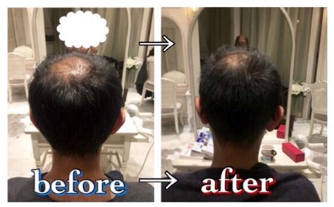 トップ 100+ メンズ 髪型 薄毛 頭頂部 - 愛の髪ベスト写真