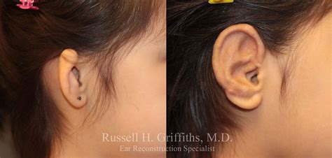 Microtia Surgery Russell H Griffiths Md