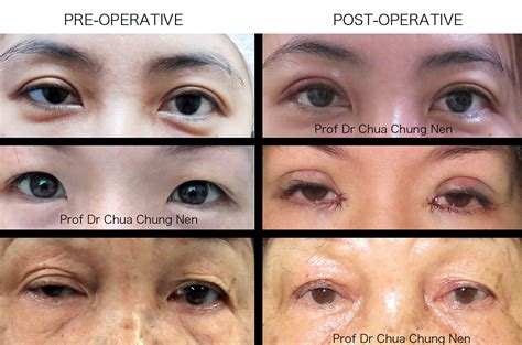 Eyelid Surgery By Prof Dr Cn Chua Postoperative Review