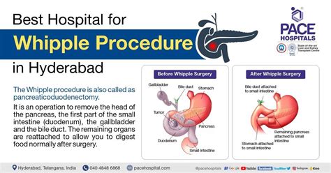 Best Hospital For Whipple Procedure In Hyderabad Surgery And Cost