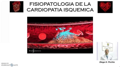 A Fisiopatologia Da Cardiopatia Isquêmica Envolve Especificamente Dois Processos