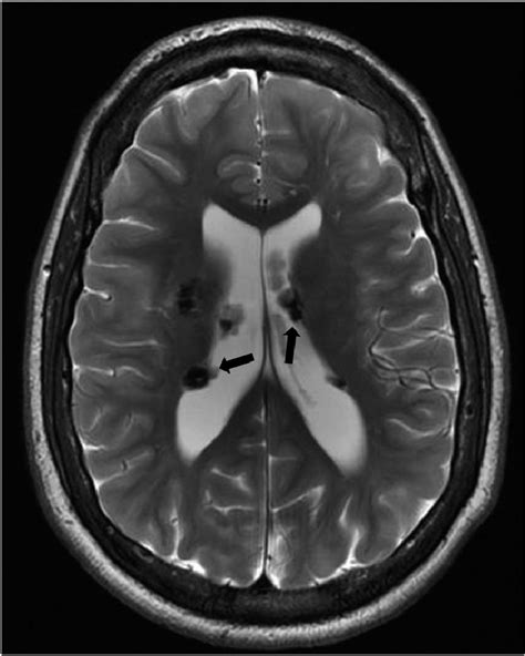 Multiple Subependymal Nodules In A Patient With Tuberous Sclerosis An