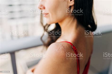 Females Sunburned Back Stock Photo Download Image Now Sun