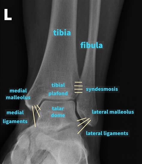 Ankle X Ray Report Template