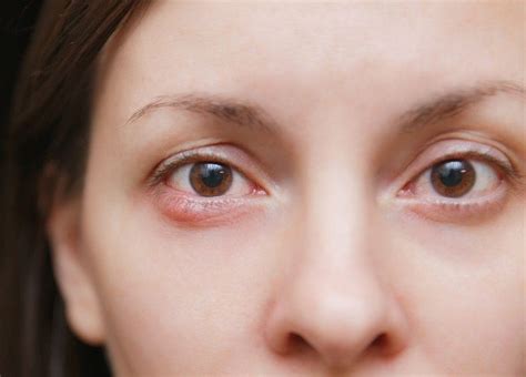 What Causes Styes And How To Avoid Them Valley Eyecare