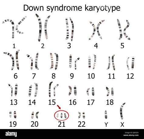 Down Syndrome Karyotype