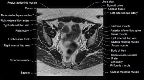 Mri Female Pelvis Anatomy Axial Image 13 Pelvis Anatomy Pelvis