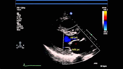 Parasternal Long Axis Views Transthoracic Echocardiogram Tte Youtube