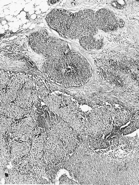 Pathology Outlines Histologic Grading