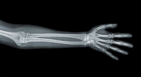 Emergency Aid And Treatment For Compound Arm Fractures