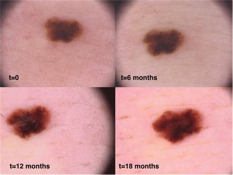 Malignant Melanoma Tumor Thickness 05 Mm The Timeline Shows The