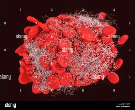 Illustration Of A Blood Clot Showing A Clump Of Red Blood Cells