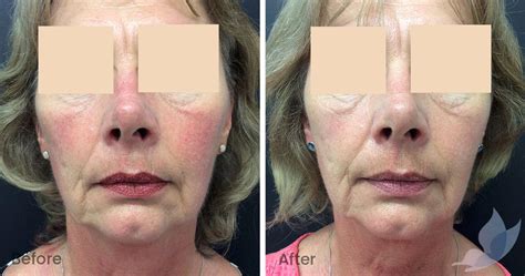 Redness And Rosacea Before And After Gallery Austin Clinic