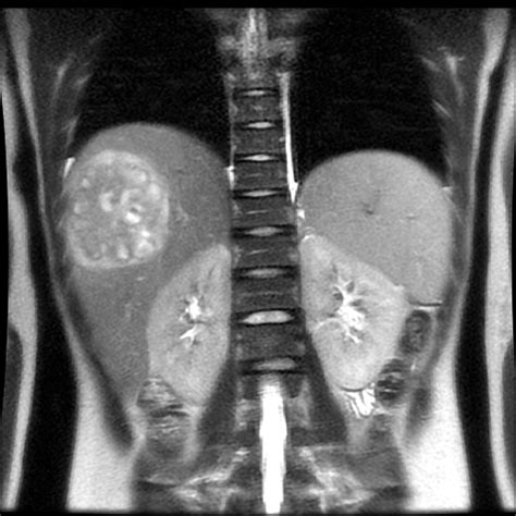 Radiology Cases Pyogenic Liver Abscess