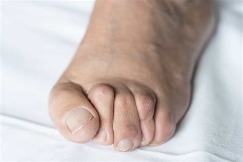 Get Relief With Claw Toe Surgery In Miami From 5000